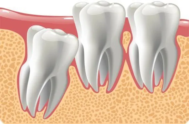 Dents de sagesse