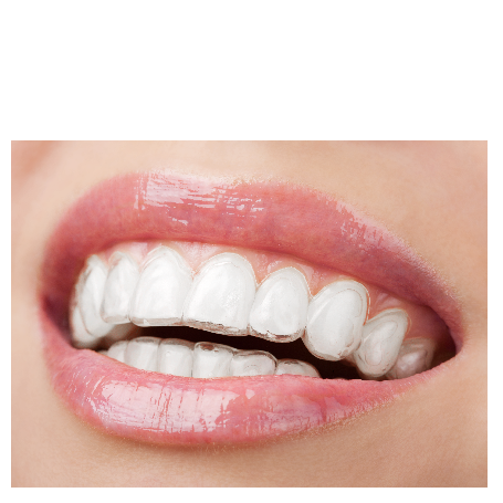 Invisalign