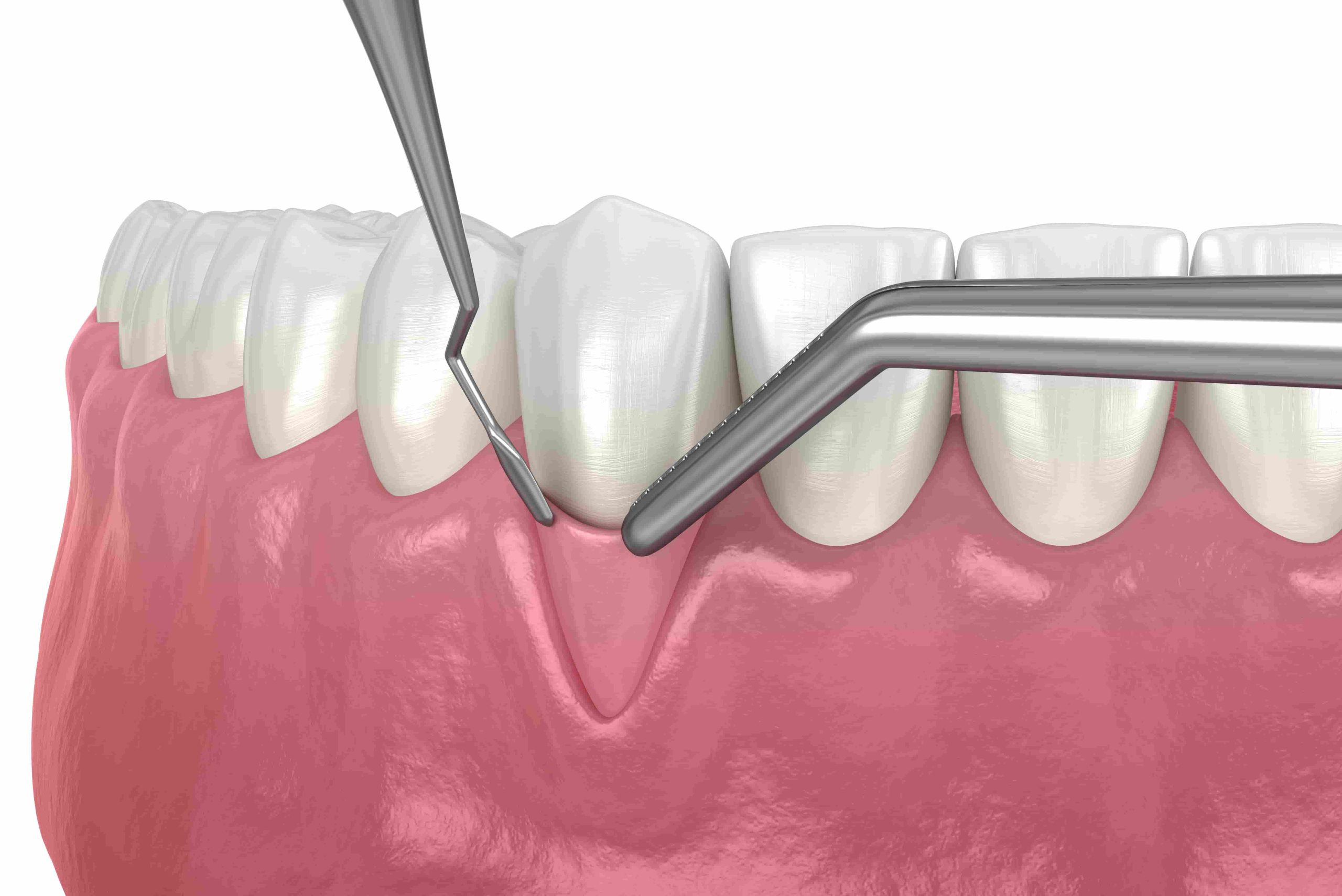 Traitement greffe gingivale à Plessisville