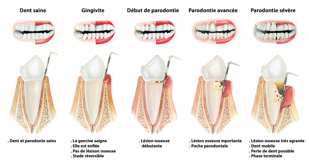 La maladie parodontale